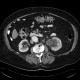 Uretherolithiasis in pyeloureteral junction, PUJ, hydronephrosis: CT - Computed tomography